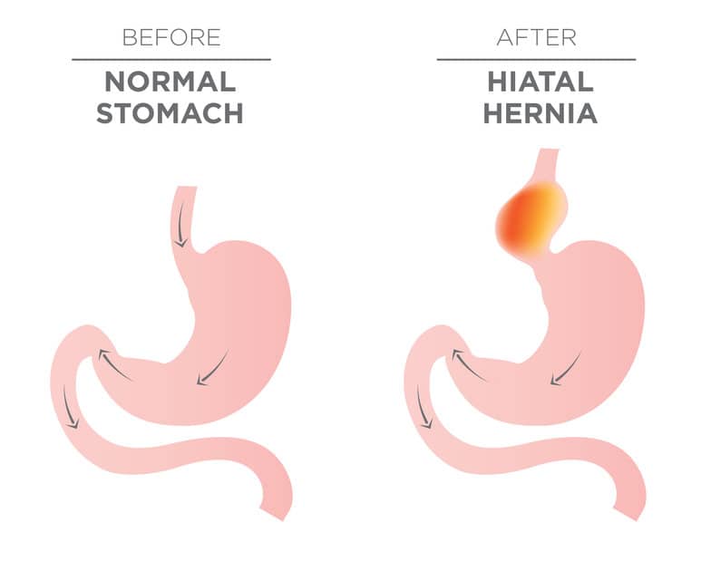 causas de la hernia de hiato