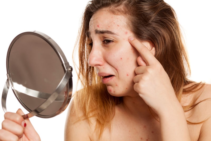 evitar el acné